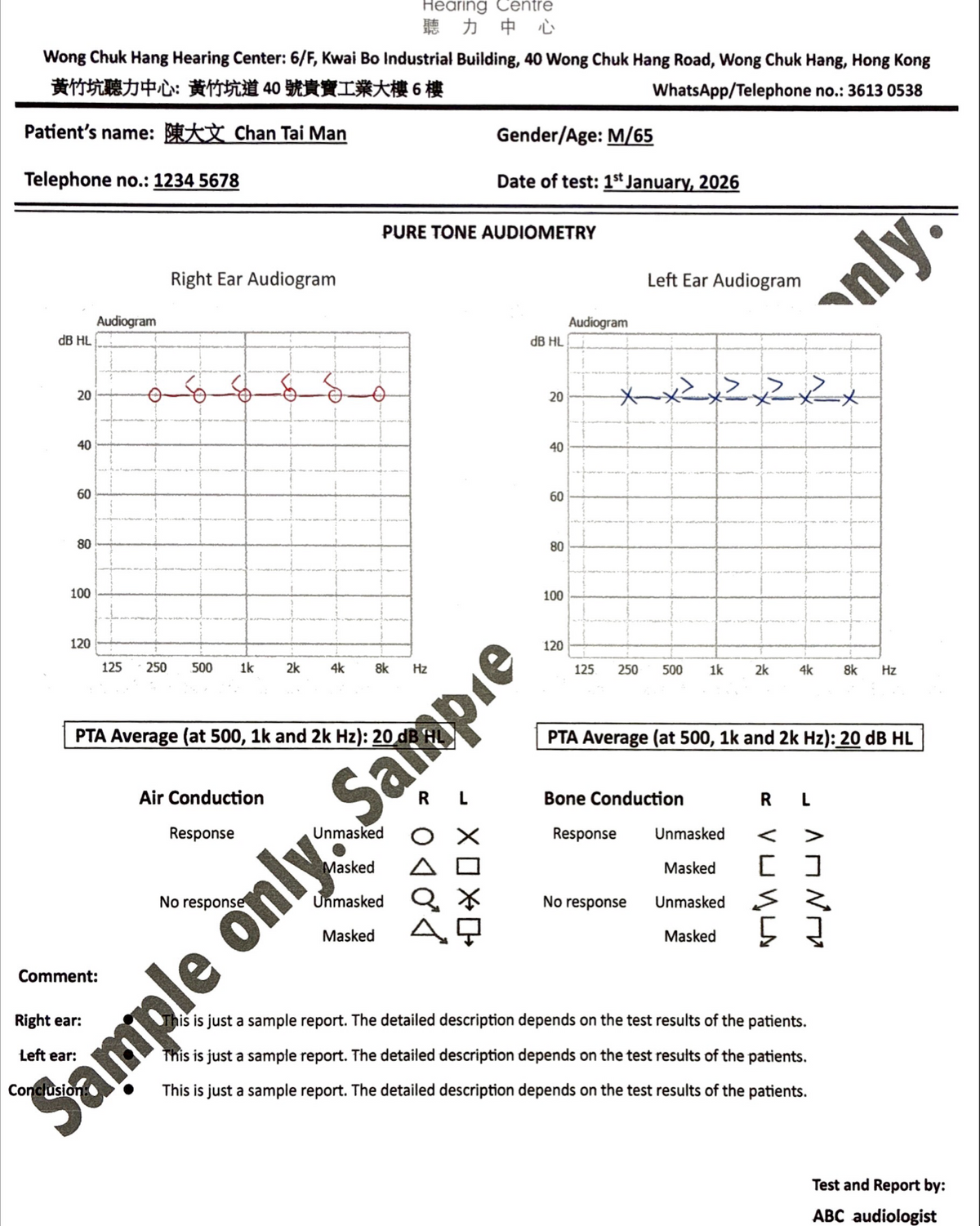 A medical pure tone audiometry report sheet showing left and right ear audiograms, average PTA values, bone conduction results, and printed patient details, with a diagonal watermark across the page
